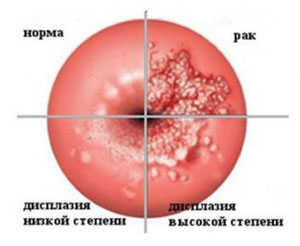эрозия шейки матки