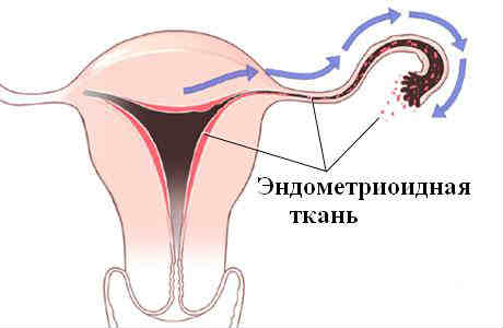 эндометриоз осложнения