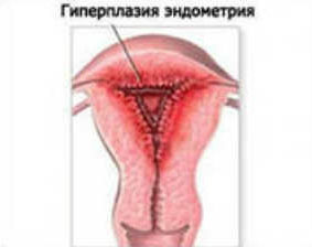 гиперплазия полипы