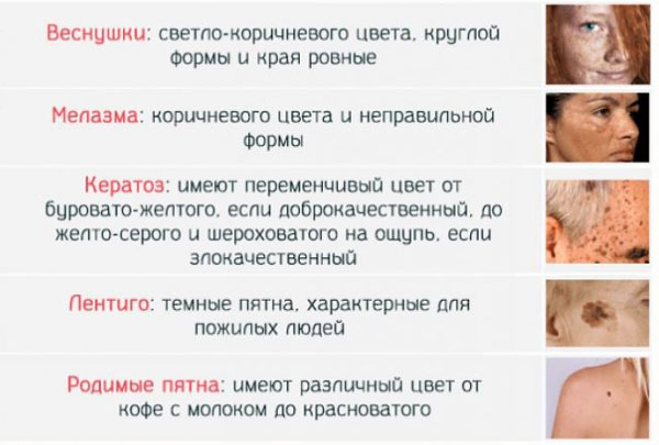 разновидности гиперпигментации