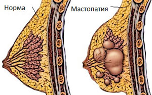 мастопатия причины