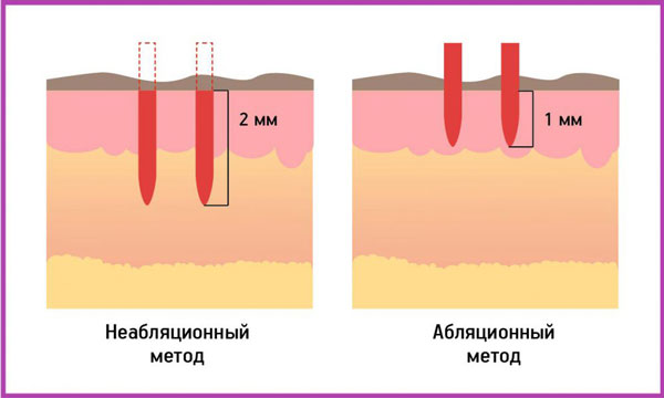неабляционное и абляционное омоложение