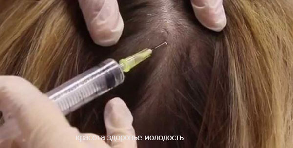 процедура мезотерапии