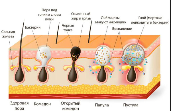 виды акне