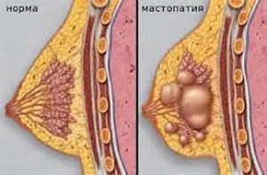 мастопатия
