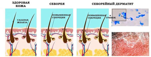 стадии появления перхоти
