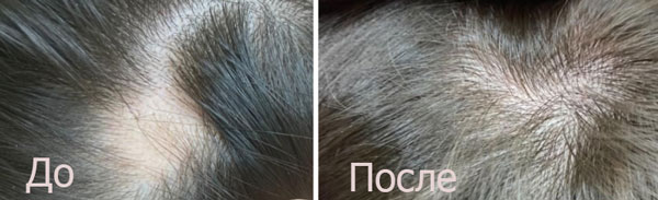 Фото: до и после процедуры